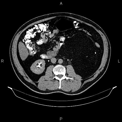 Retroperitoneal Lipoma Image Radiopaedia Org