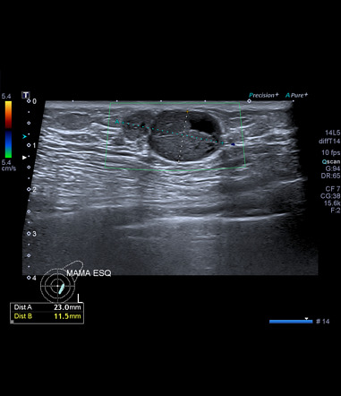 Intracystic Papillary Carcinoma Breast Radiology Reference Article