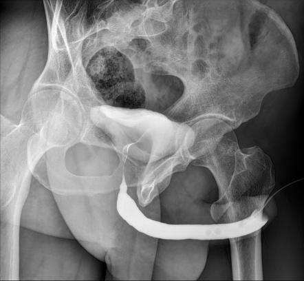 Normal Retrograde Urethrogram And Voiding Cystourethrogram Radiology Case Radiopaedia Org