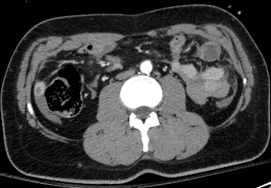 Mesenteric Traumatic Lacerations Image Radiopaedia Org