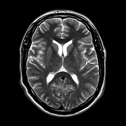 Complicated Brainstem Cavernoma And Developmental Venous Anomaly