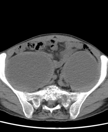 Extensive Pott Disease With Large Psoas Muscles Abscesses Image