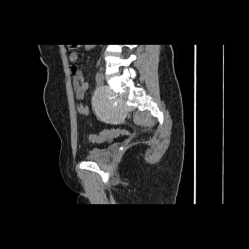 Extramedullary Hematopoiesis Presacral Mass Image Radiopaedia Org