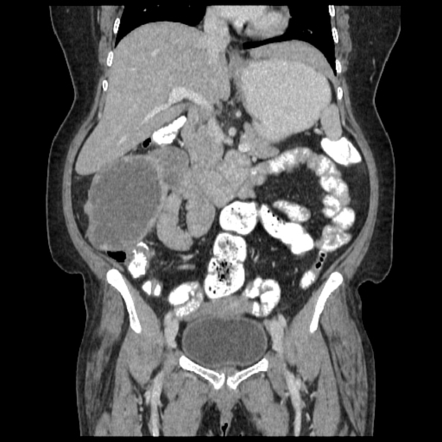 Gastrointestinal Stromal Tumour Radiology Case Radiopaedia Org