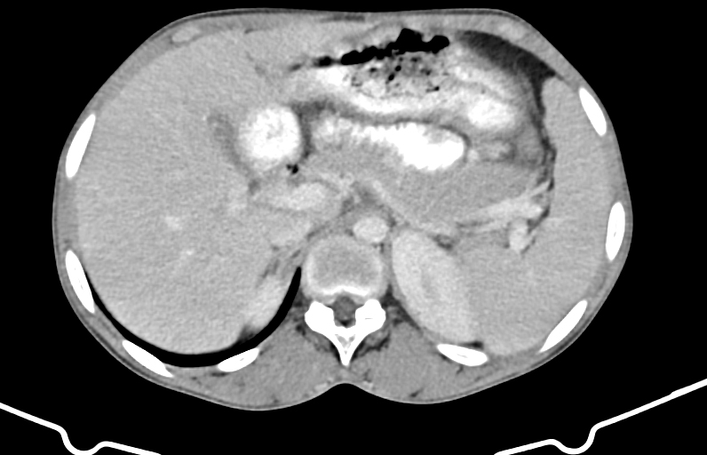 Tuberculous Spondylitis Pott Disease With Large Psoas Abscesses