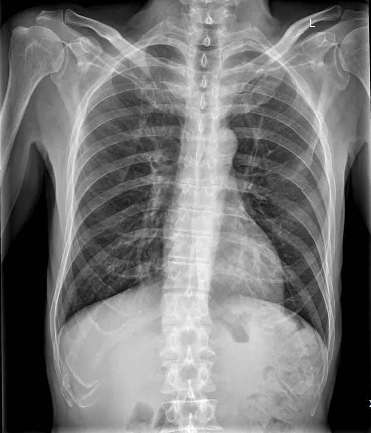 Rib Fracture Image Radiopaedia Org