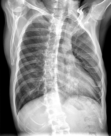 Rib Fracture Image Radiopaedia Org