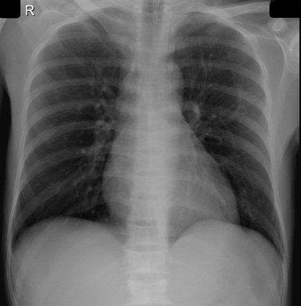 H Shaped Vertebrae Sickle Cell Disease Radiology Case Radiopaedia Org