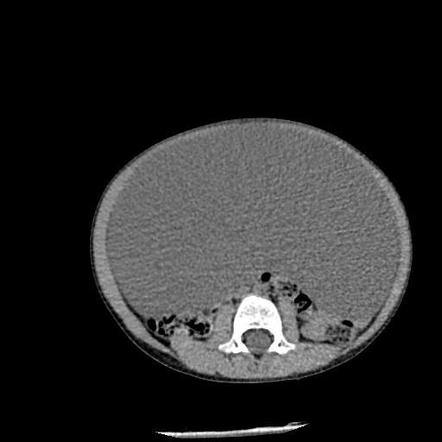 Benign Peritoneal Mesothelioma Radiology Case Radiopaedia Org