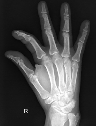 Metacarpal Fracture Radiology Case Radiopaedia Org