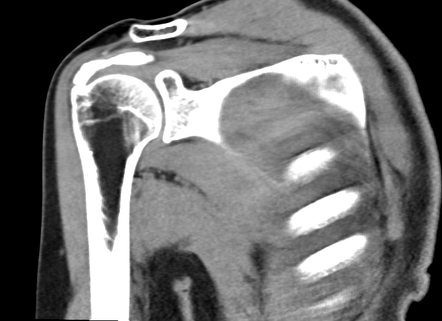 Calcific Tendinitis Of The Supraspinatus Tendon Image Radiopaedia Org