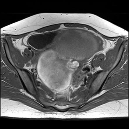 Ovarian Torsion Due To Hemorrhagic Cyst Radiology Case Radiopaedia Org