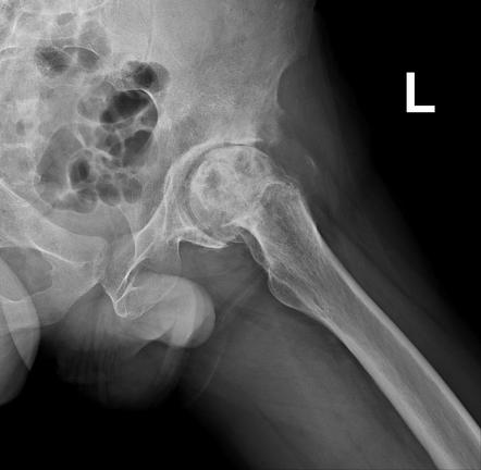 Avascular Necrosis Of The Hip Radiology Case Radiopaedia Org