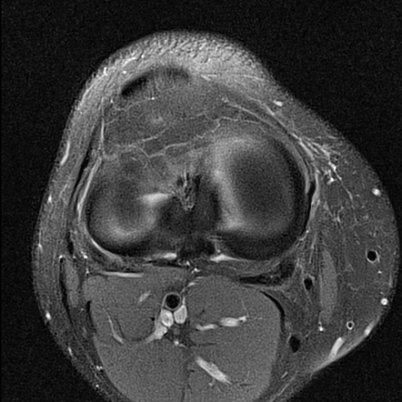 Medial Gastrocnemius Origin Ganglion Cyst Image Radiopaedia Org