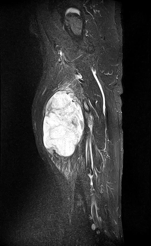 Myxoid Liposarcoma Soft Tissues Image Radiopaedia Org