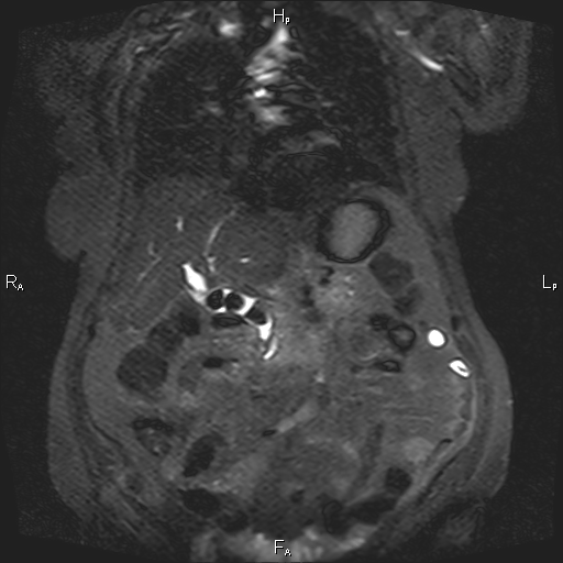 Cholelithiasis And Choledocholithiasis Image Radiopaedia Org