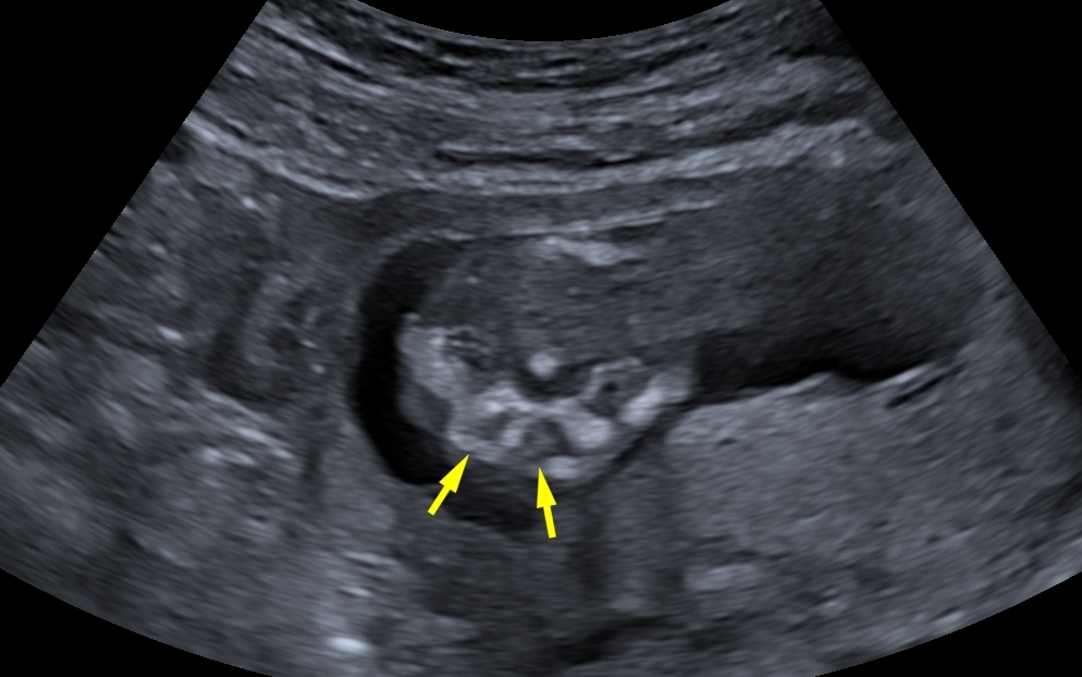 Alobar Holoprosencephaly Antenatal Image Radiopaedia Org