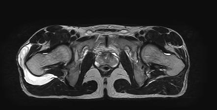 Trochanteric Bursitis Radiology Reference Article Radiopaedia Org