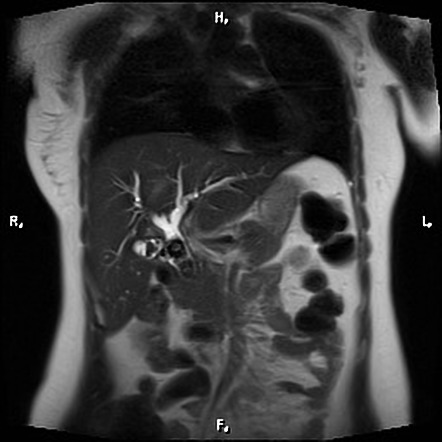 Cholelithiasis And Choledocholithiasis Radiology Case Radiopaedia Org