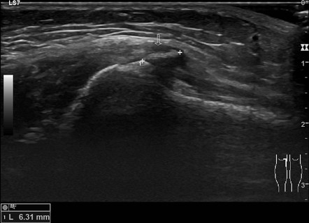 Pes Anserinus Spur Radiology Case Radiopaedia Org