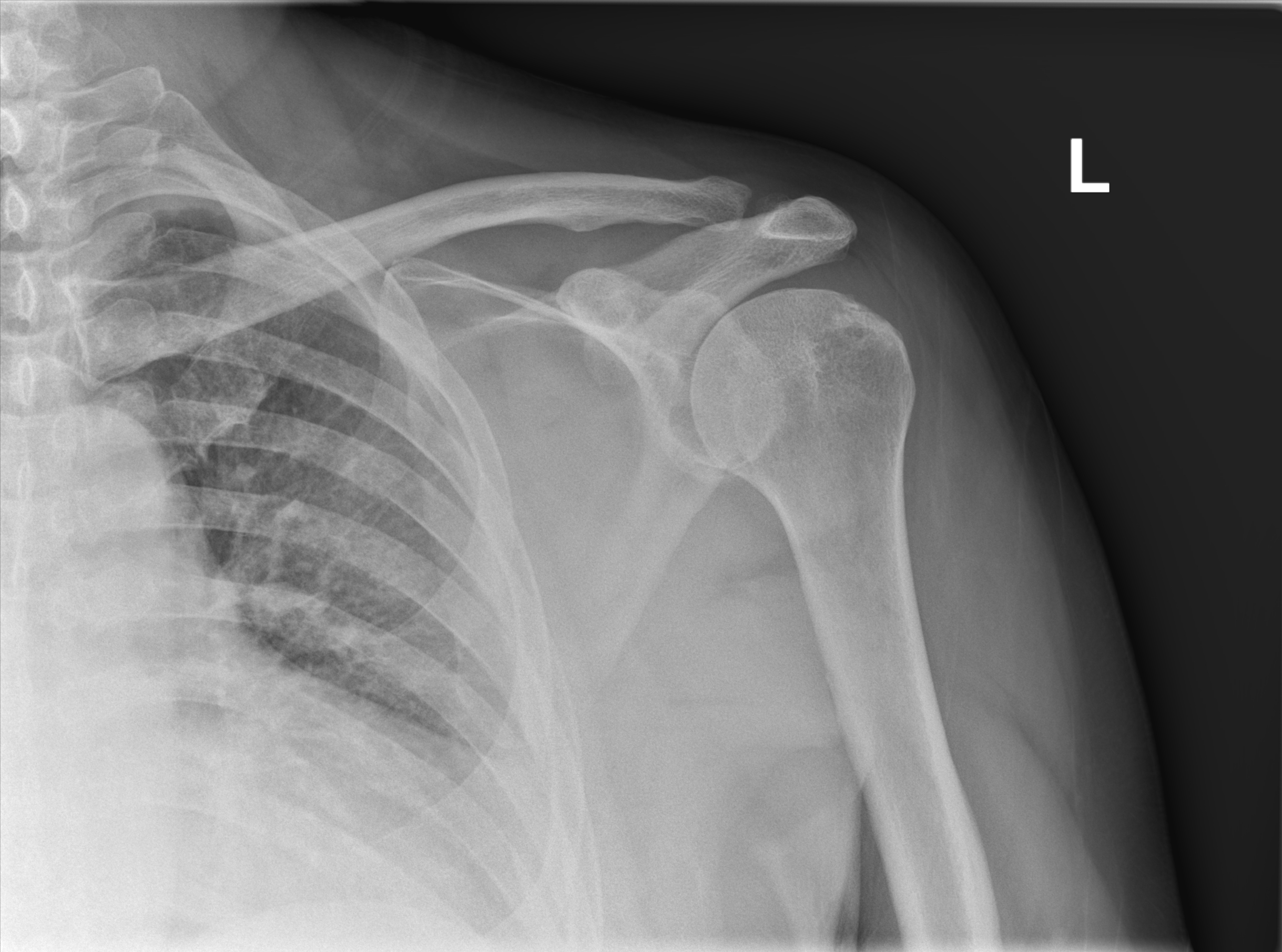 Bony Bankart Lesion Subtle X Ray Image Radiopaedia Org