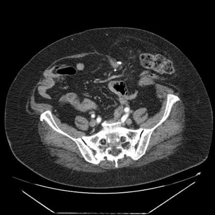 Parastomal Hernia Image Radiopaedia Org