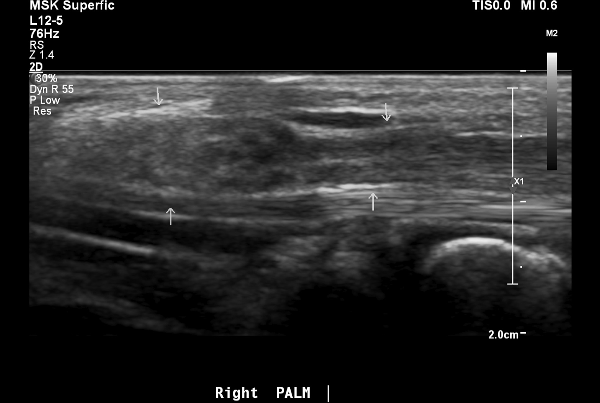 Fibrolipomatous Hamartoma Of The Median Nerve Image Radiopaedia Org