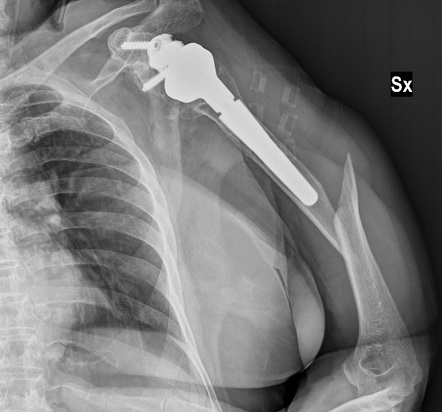 Wright And Cofield Classification Of Postoperative Periprosthetic