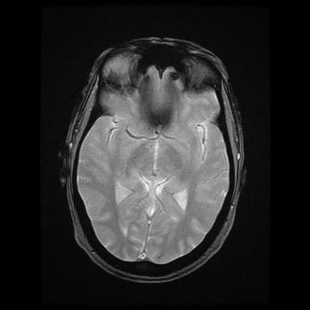 Choroid Plexus Xanthogranulomas Image Radiopaedia Org