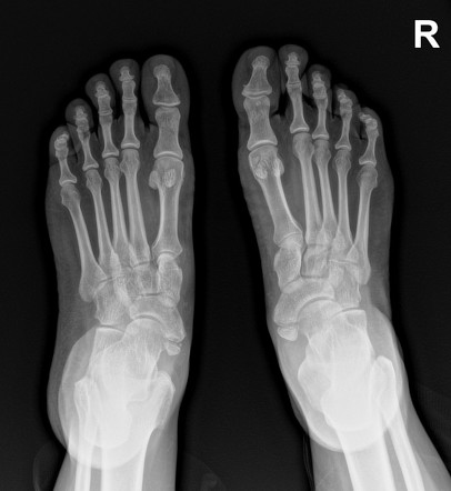 Accessory Navicular Bones Bilaterally Radiology Case Radiopaedia Org