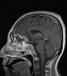 Rhino Orbito Cerebral Mucormycosis Image Radiopaedia Org