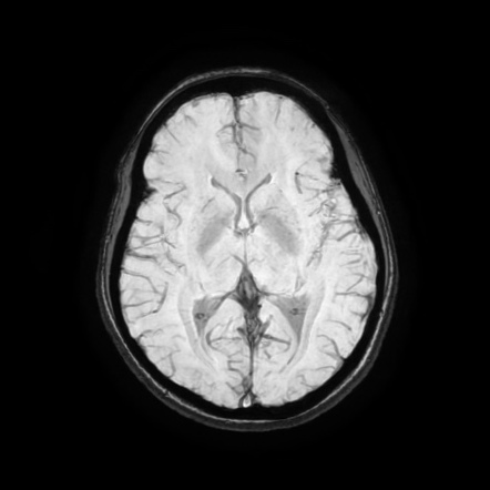 Intracranial Epidermoid Cyst Image Radiopaedia Org