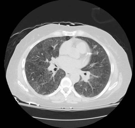 Pulmonary Alveolar Proteinosis Radiology Case Radiopaedia Org