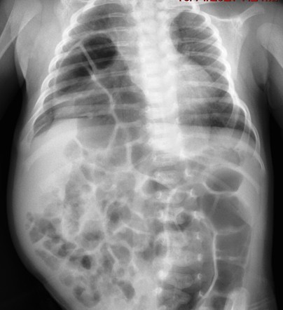 Morgagni Hernia Radiology Case Radiopaedia Org