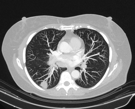 Pulmonary Adenocarcinoma Image Radiopaedia Org