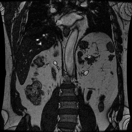 Adrenal Adenoma Image Radiopaedia Org