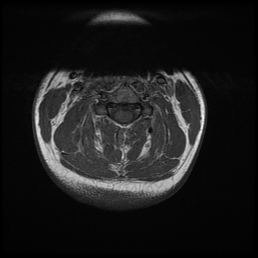 Cervical Extension Teardrop Fracture Image Radiopaedia Org