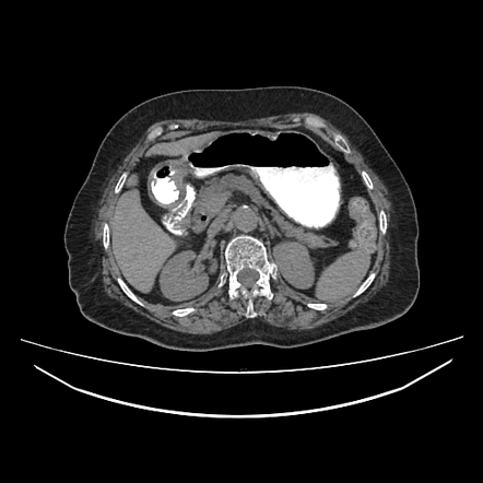 Cholecystoduodenal Fistula Radiology Case Radiopaedia Org