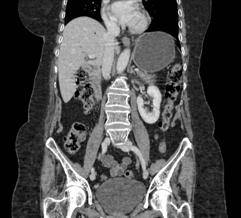 Cholecystoduodenal Fistula Image Radiopaedia Org