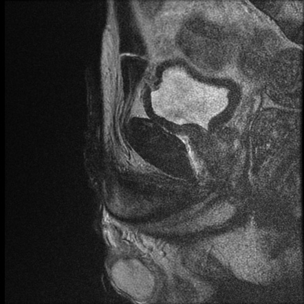 Corpora Cavernosal Infarction Image Radiopaedia Org