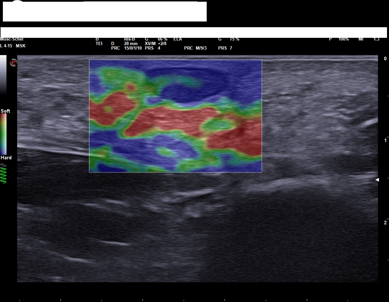 Superficial Femoral Artery Occlusion Image Radiopaediaorg