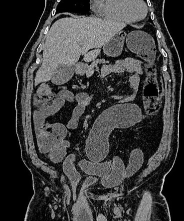 Urinary Bladder Hernia Radiology Case Radiopaedia Org