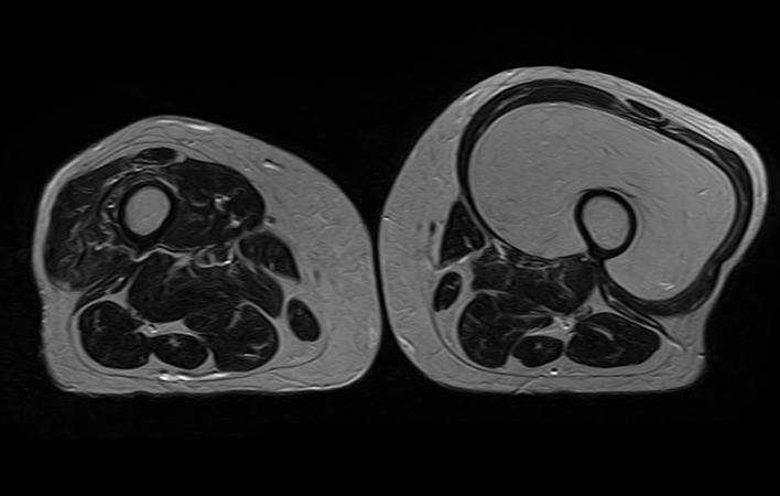 Intramuscular Lipoma Vastus Intermedius Image Radiopaedia Org