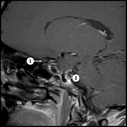 MRI Pituitary Gland Sagittal T1 Post Contrast Labelling Questions