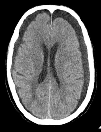 Chronic Subdural Haematoma Radiology Case Radiopaedia Org