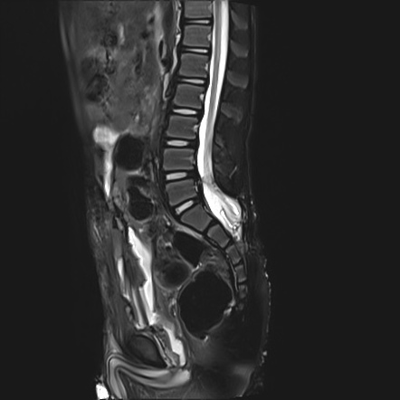 Spina Bifida With Tethered Cord And Myelomeningocele Radiology Case