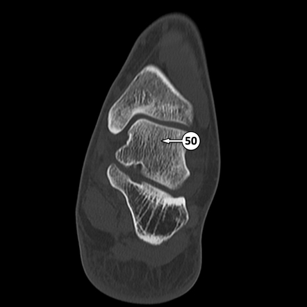 Talus Radiology Reference Article Radiopaedia Org