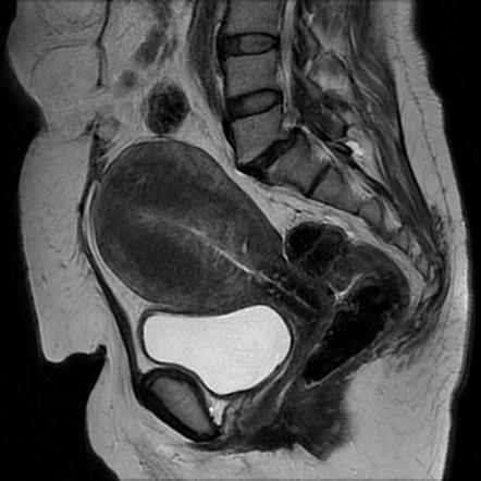 Diffuse Uterine Adenomyosis Radiology Case Radiopaedia Org