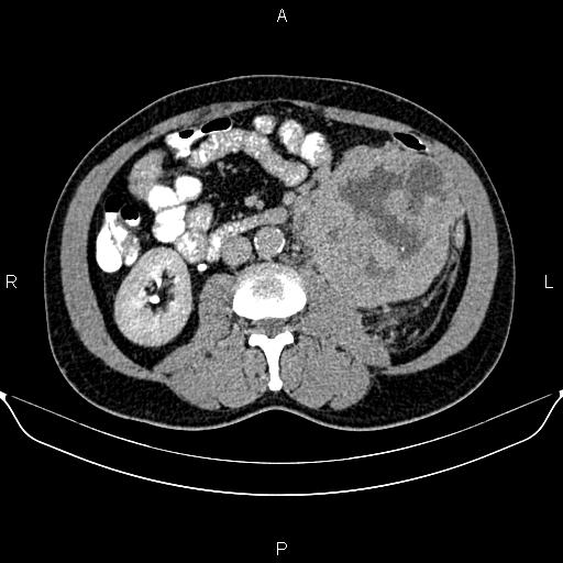 Metastatic Renal Cell Carcinoma With Synchronous Urinary Bladder