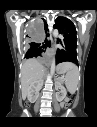 Malignant Mesothelioma Radiology Case Radiopaedia Org